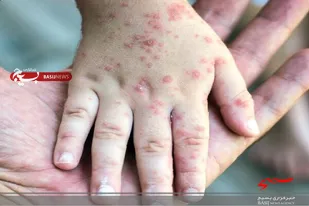 ضرورت واکسیناسیون کودکان لرستانی علیه بیماری سرخک