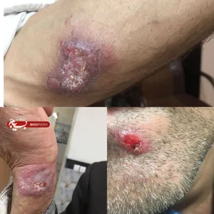 شناسایی اولین مورد ابتلا به سالک در پیشوا
